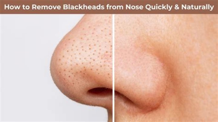 Do nose strips remove blackheads?