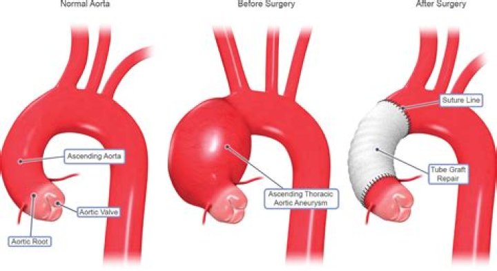 How long does aortic aneurysm surgery take?