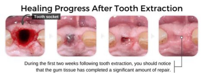 How long does it take for a tooth to break through the gums?