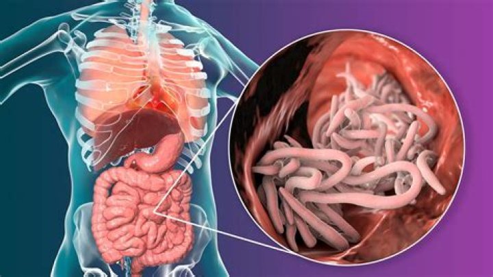 What are the symptoms of ascariasis?