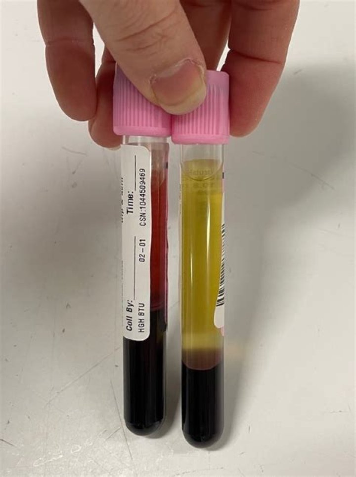 What does it mean when a sample is slightly Hemolyzed?