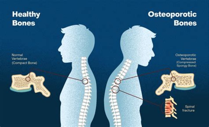 Where do you get pain with osteoporosis?