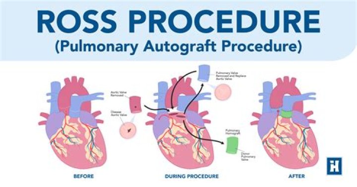 Where is an autograft?